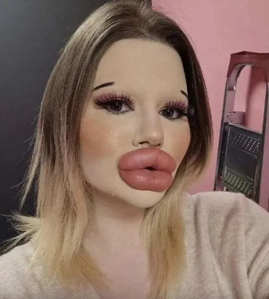 24-year-old Bulgarian woman wants to have the biggest lips in the world