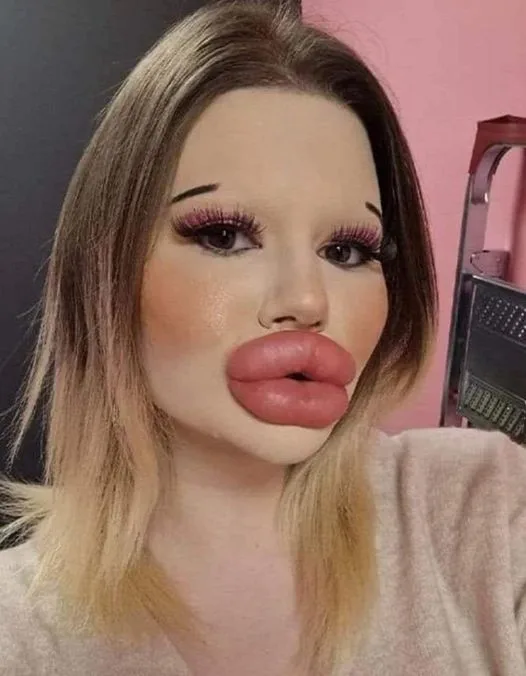 24-year-old woman wants to have the biggest lips in the world